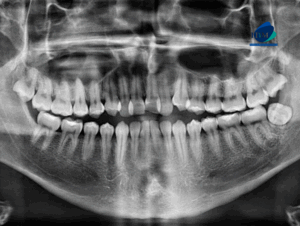 CASO 313 IDM radiografia panoramica 01