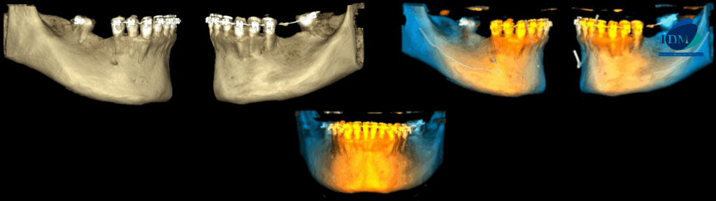 CASO 314 IDM RECONSTRUCCION 3D