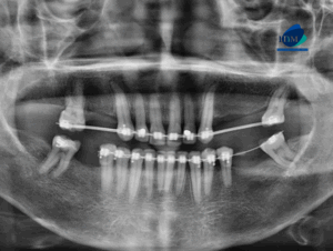 CASO 314 IDM radiografia panoramica 01
