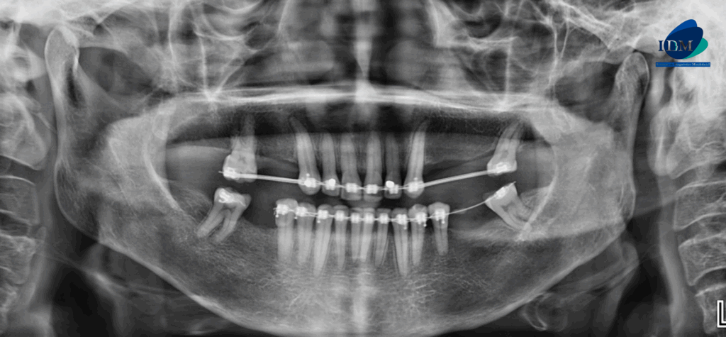 CASO 314 IDM radiografia panoramica 02