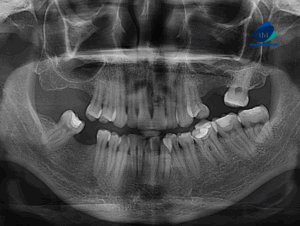 CASO 315 IDM radiografia panoramica 01