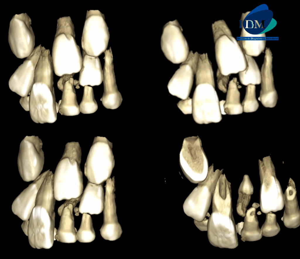 CASO 316 IDM RECONSTRUCCION 3D