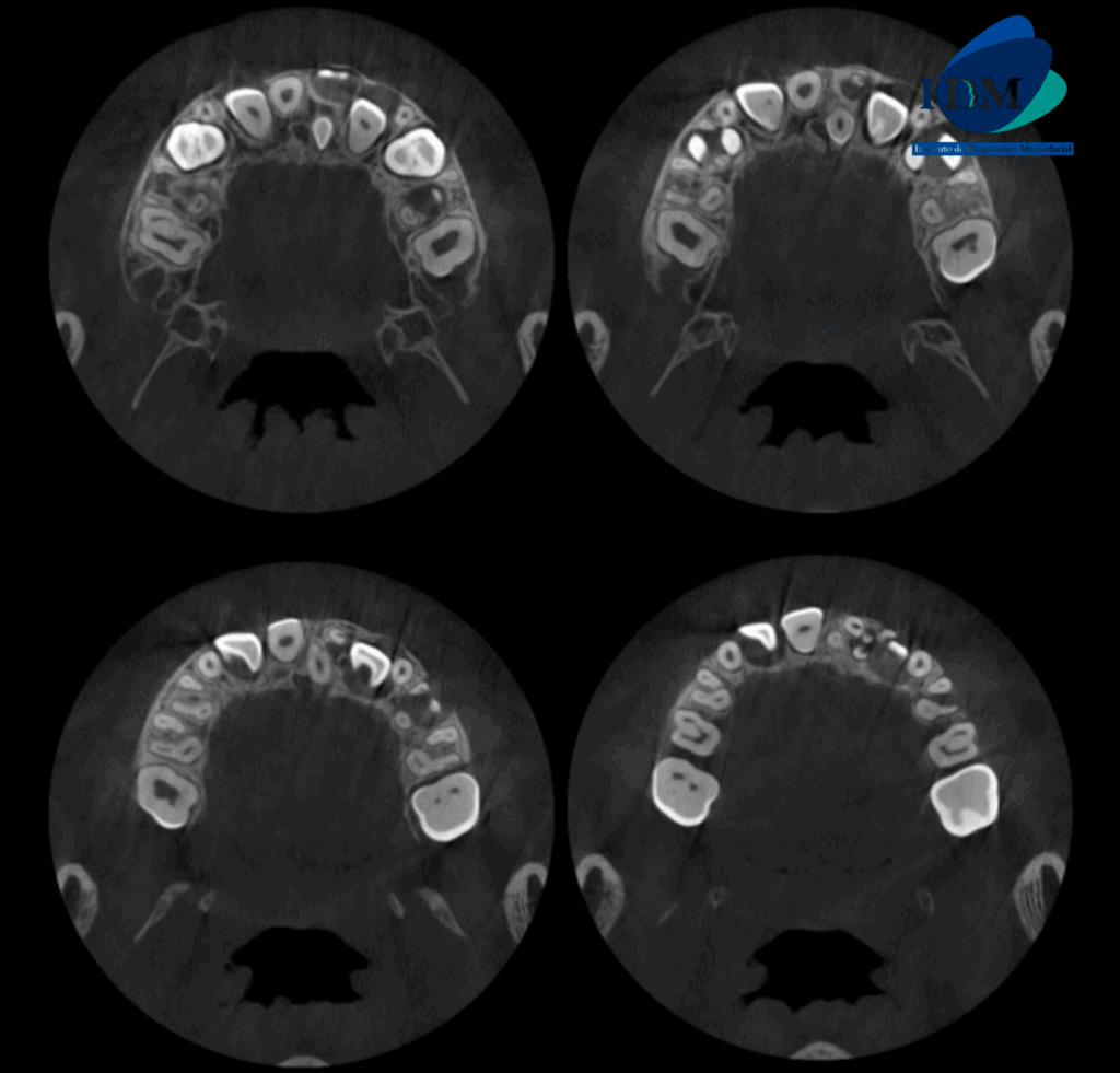 CASO 316 IDM cortes axiales