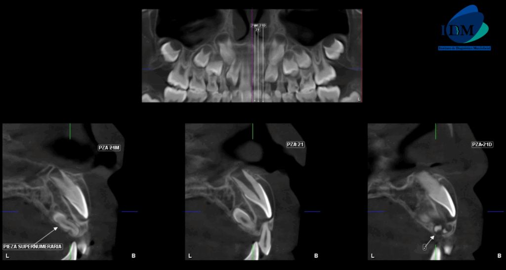 CASO 316 IDM cortes transaxiales