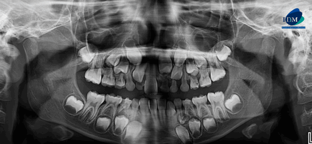 CASO 316 IDM radiografia panoramica 02