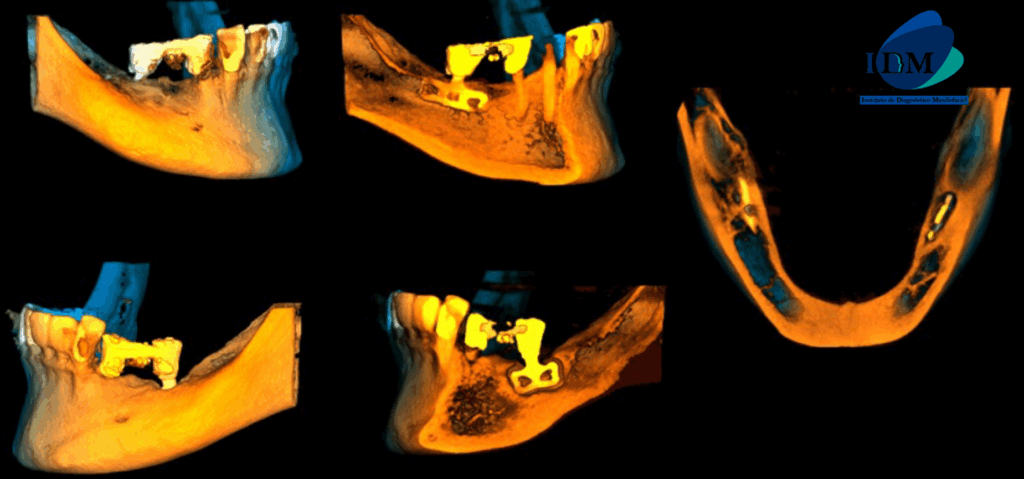 CASO 317 IDM RECONSTRUCCION 3D