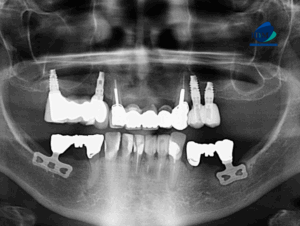CASO 317 IDM radiografia panoramica 01