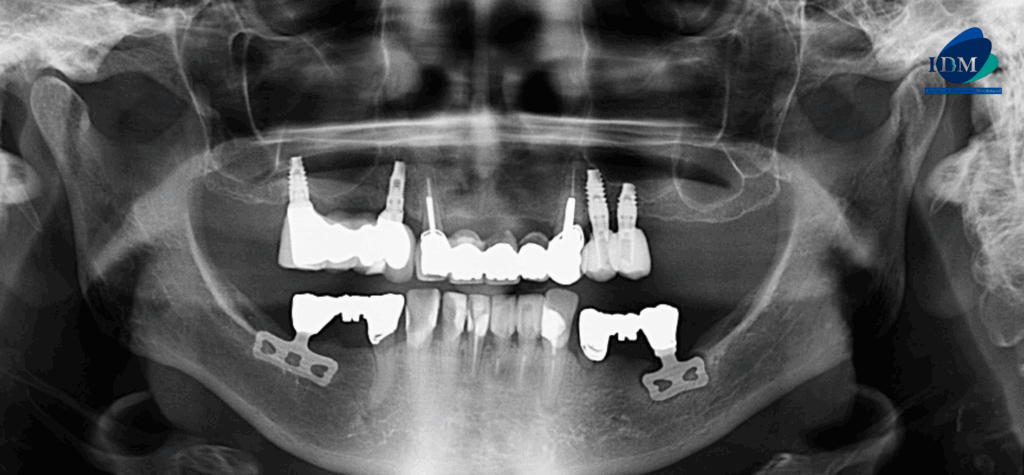 CASO 317 IDM radiografia panoramica 02