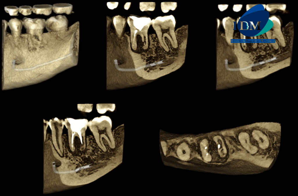 CASO 318 IDM RECONSTRUCCION 3D