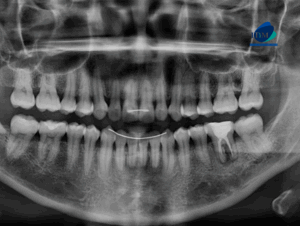 CASO 318 IDM radiografia panoramica 01