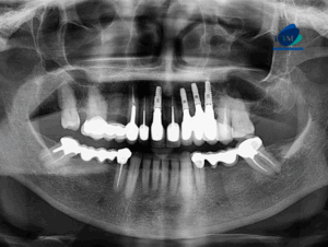CASO 319 - radiografia panoramica 01