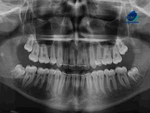 CASO 320 IDM - radiografia panoramica 01