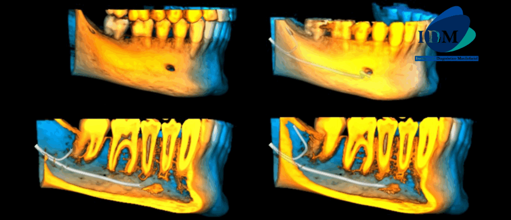 CASO 321 IDM - RECONSTRUCCION 3D