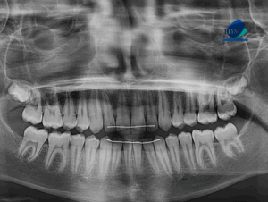 CASO 321 IDM - radiografia panoramica 01