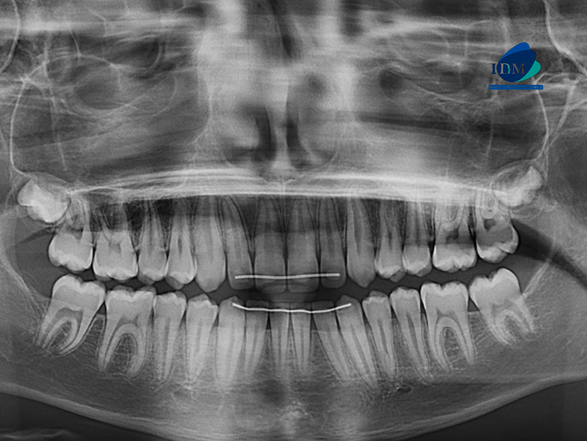 CASO 321 IDM - radiografia panoramica 01