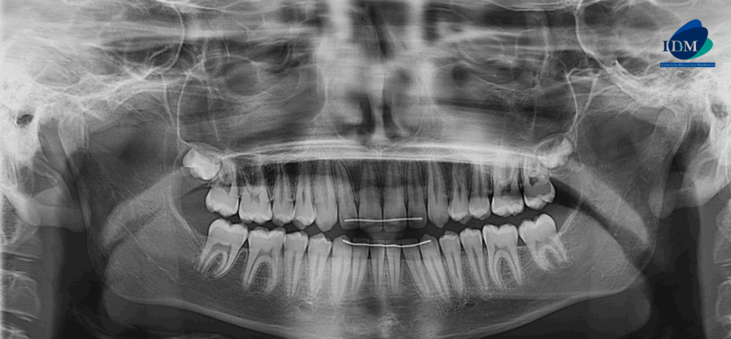 CASO 321 IDM - radiografia panoramica 02