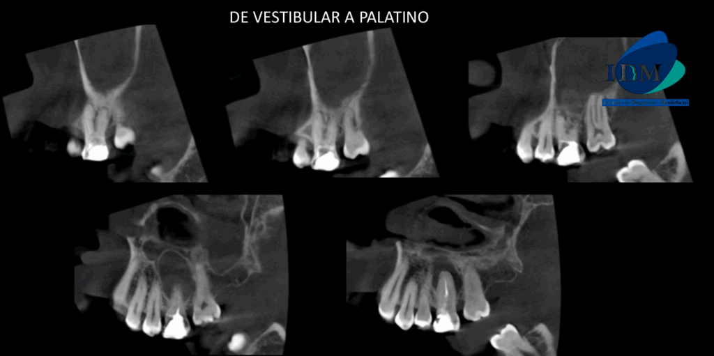 CASO 322 IDM - CORTES TANGENCIALES