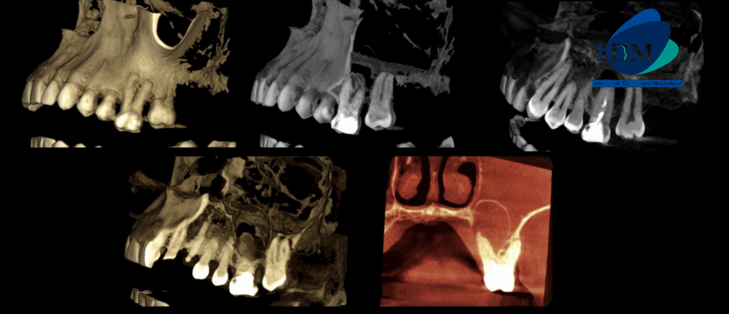 CASO 322 IDM - RECONSTRUCCION 3D
