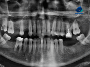 CASO 322 IDM - radiografia panoramica 01