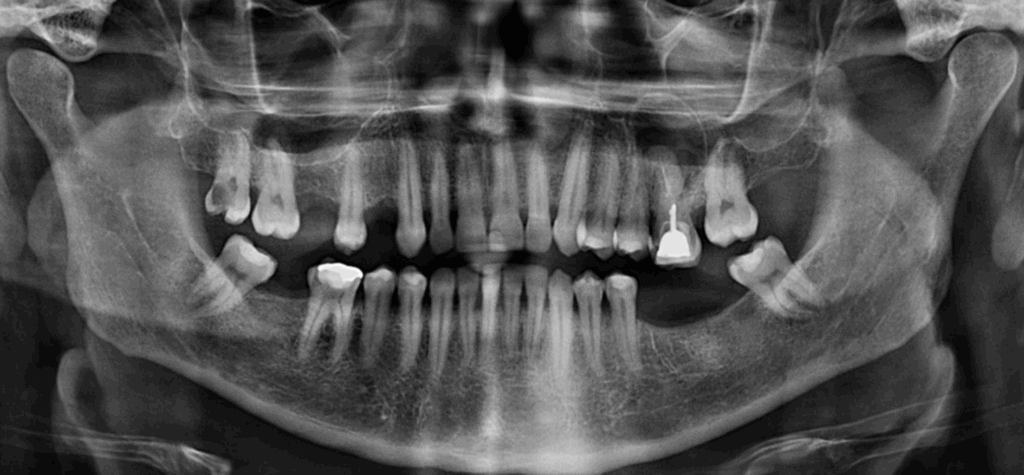 CASO 322 IDM - radiografia panoramica 02