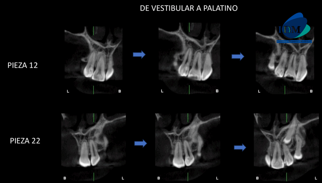 CASO 323 IDM - CORTES TANGENCIALES