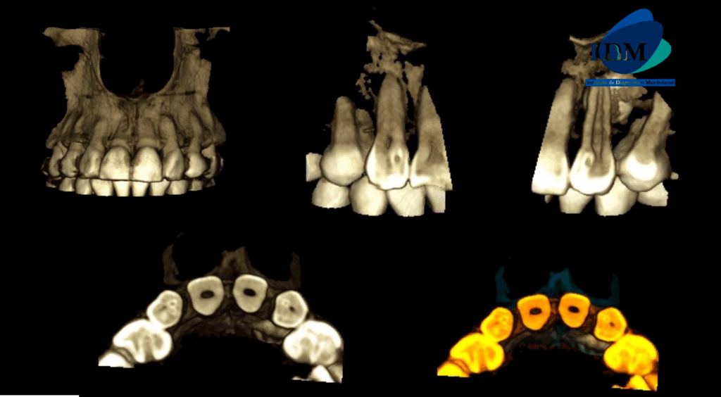 CASO 323 IDM - RECONSTRUCCION 3D