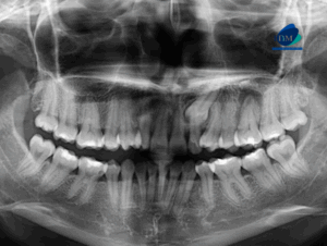 CASO 323 IDM - radiografia panoramica 01