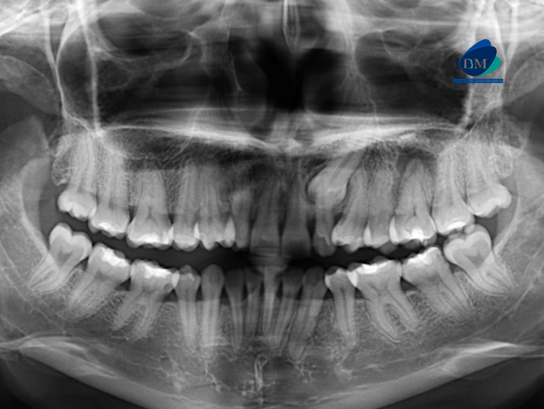 CASO 323 IDM - radiografia panoramica 01