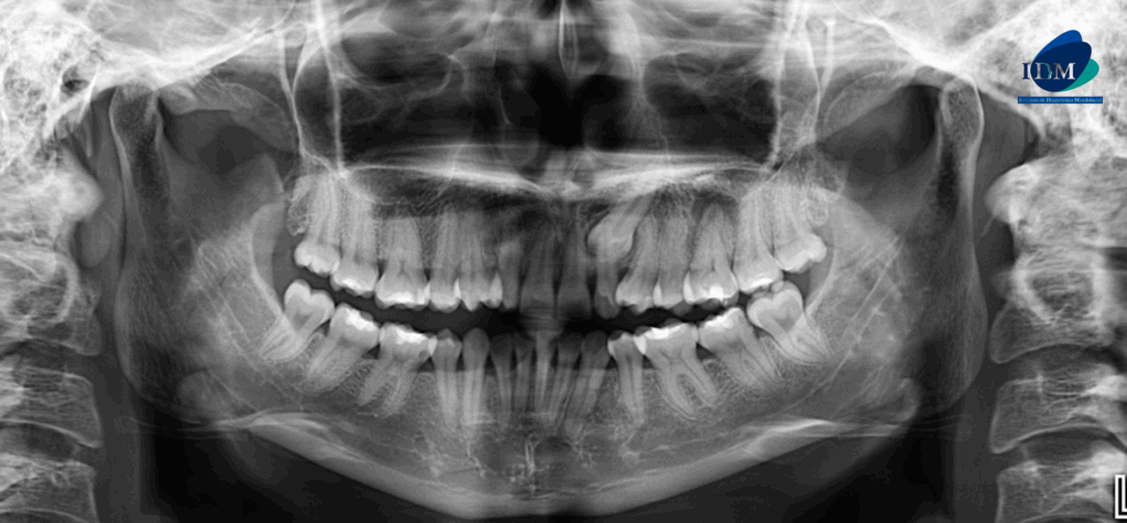 CASO 323 IDM - radiografia panoramica 02