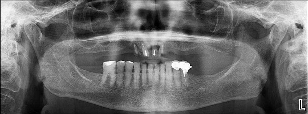 CASO 324 IDM CANALIS SINUOSUS_PANORAMICA