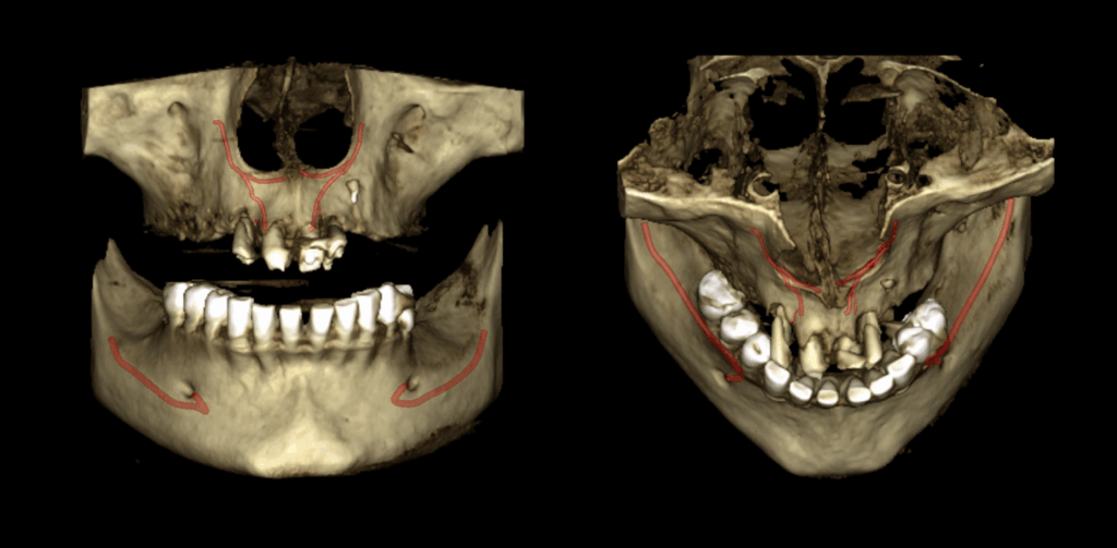 CASO 324 IDM CANALIS SINUOSUS_RECONSTRUCCION 3D 02