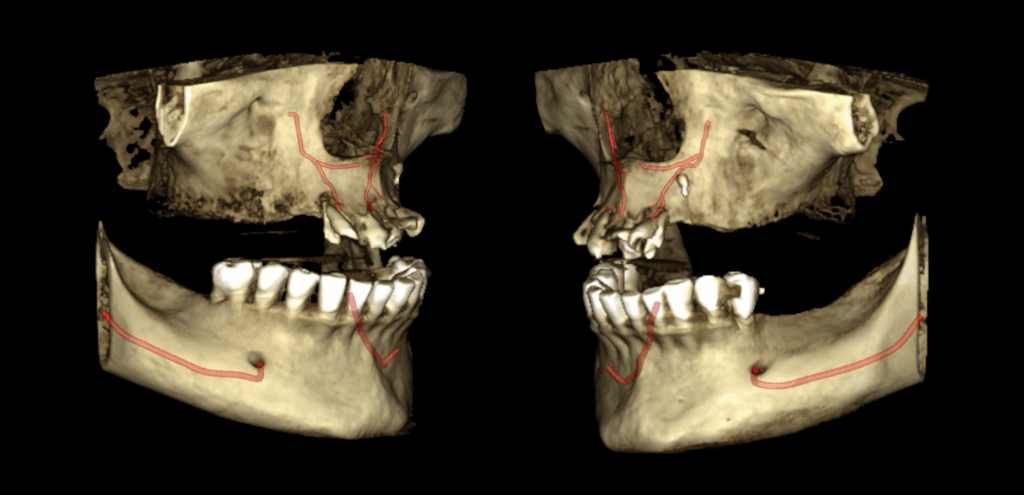 CASO 324 IDM CANALIS SINUOSUS_RECONSTRUCCION 3D