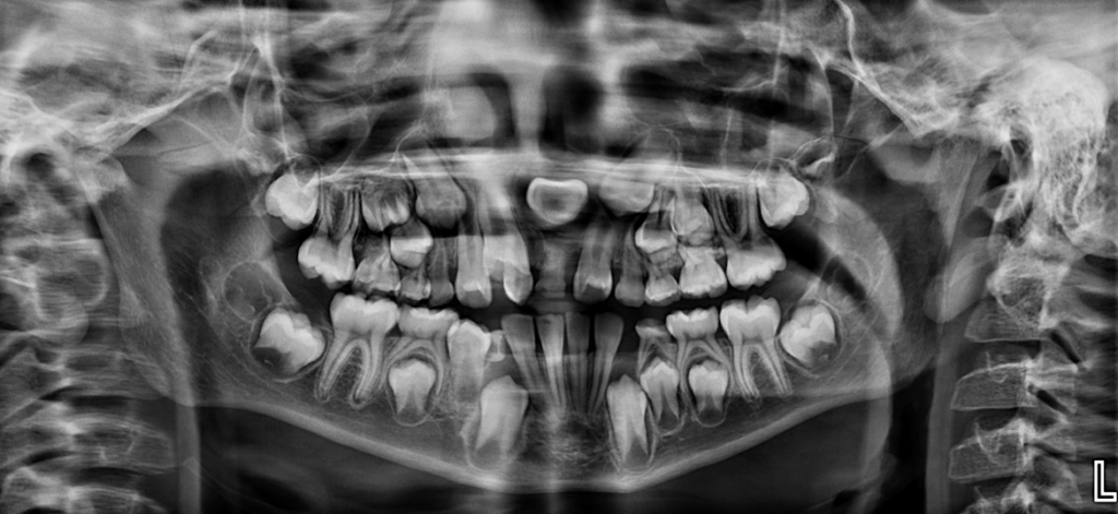 CASO 333 - RADIOGRAFIA PANORAMICA - IDM