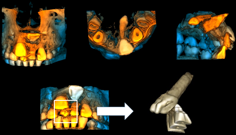 CASO 333 - RECONSTRUCCION 3D - IDM