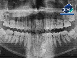Caso 325 – IDM – RADIOGRAFIA PANORAMICA 01 – IDM