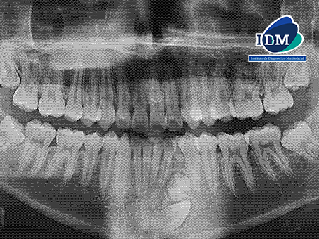 Caso 325 – IDM – RADIOGRAFIA PANORAMICA 01 – IDM