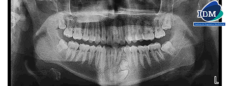Caso 325 – IDM – RADIOGRAFIA PANORAMICA 02 – IDM