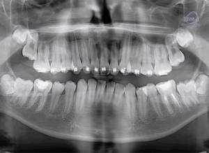 caso 324 IDM - radiografia panoramica IDM CANALIS SINUOSUS_PANORAMICA