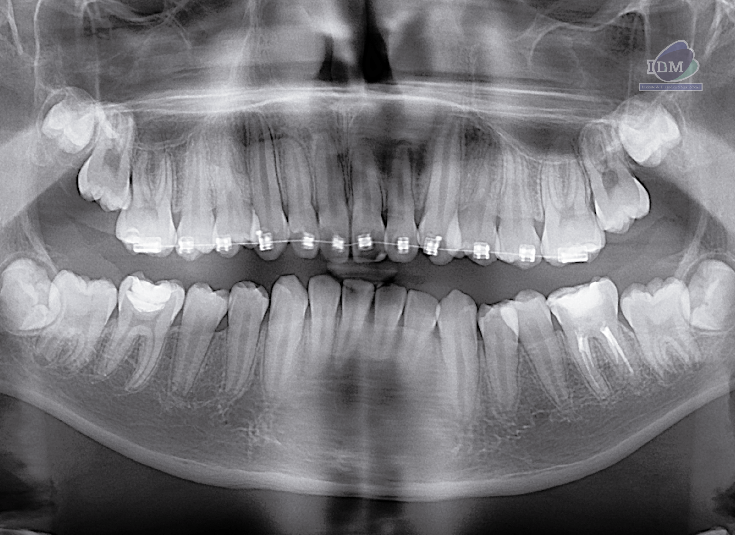 caso 324 IDM - radiografia panoramica IDM CANALIS SINUOSUS_PANORAMICA
