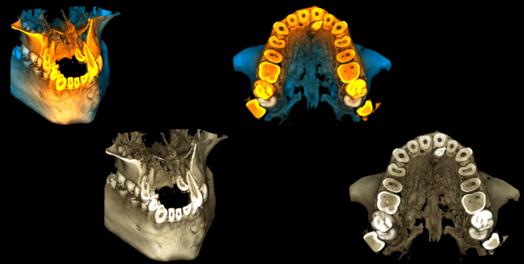 caso 325 reconstruccion 3d 01odontoma, mesiodens y raíces supernumerarias en molares inferiores_Página_8