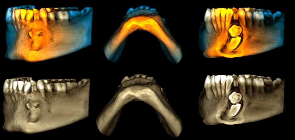 caso 325 reconstruccion 3d 02 odontoma, mesiodens y raíces supernumerarias en molares inferiores_Página_9