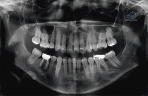 caso 326 radiografia panoramica 01