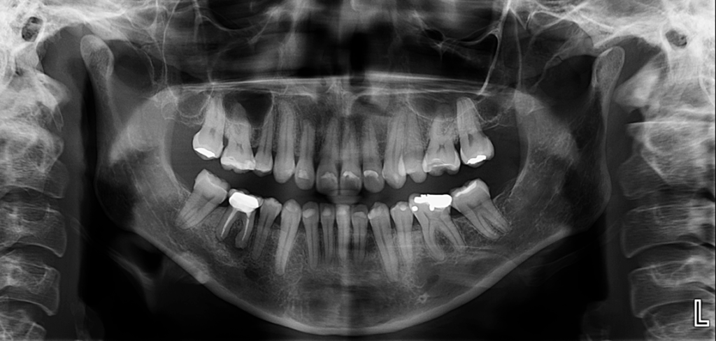 caso 326 radiografia panoramica