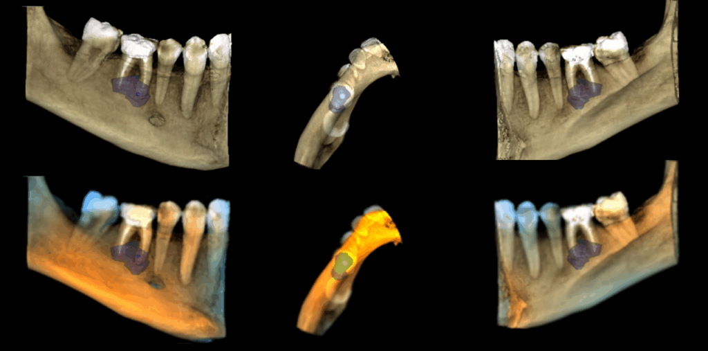 caso 326 reconstruccion 3d