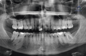 caso 327 - radiografia panoramica IDM 02