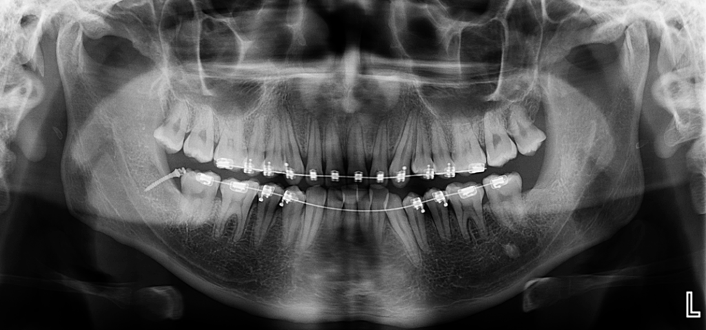 caso 328 idm raciografia panoramica