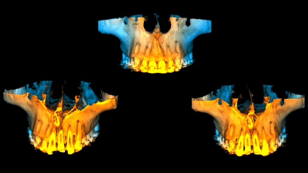 caso 328 idm reconstruccion 3D