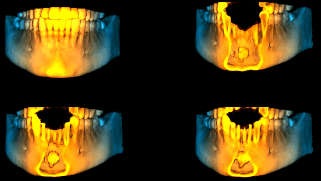 caso 329 idm reconstruccion 3D