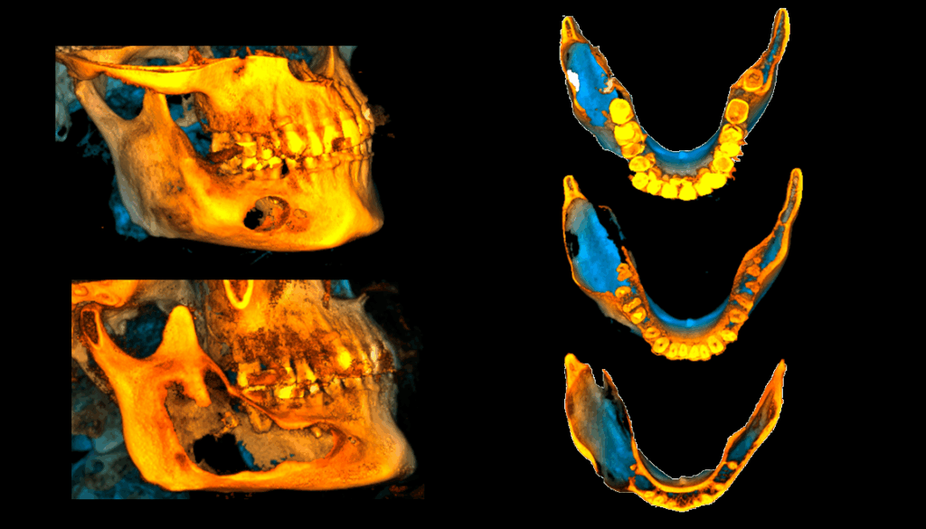 caso 330 idm RECONSTRUCCION 3D