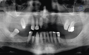 caso 331 idm radiografia panoramica 01